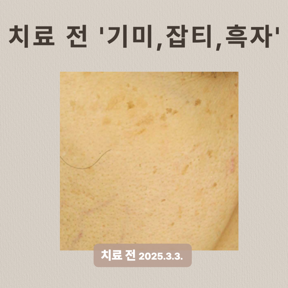 기미, 잡티, 흑자