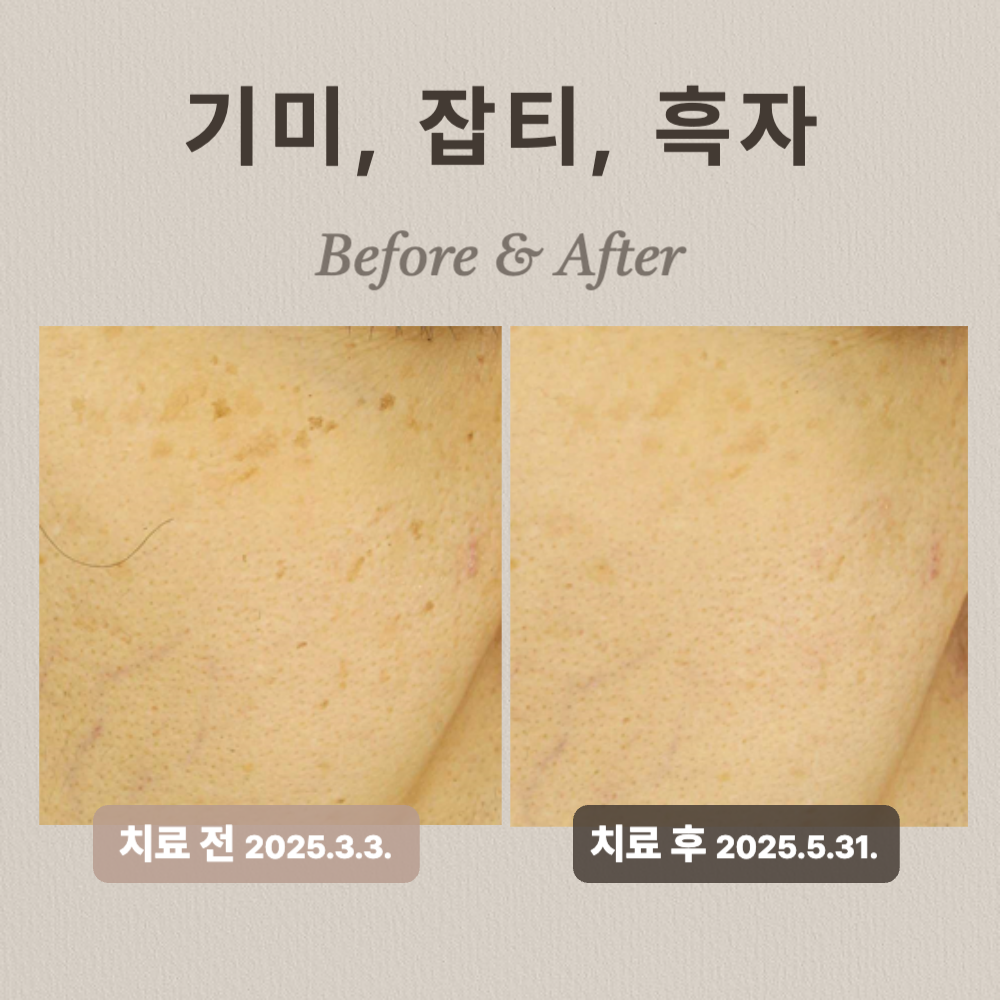 기미, 잡티, 흑자