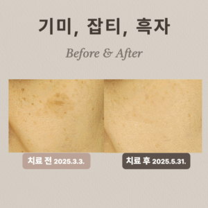 기미, 잡티, 흑자