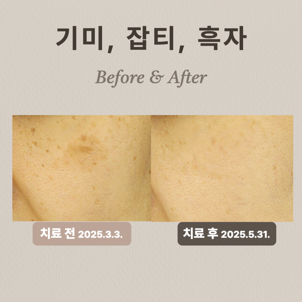 기미, 잡티, 흑자