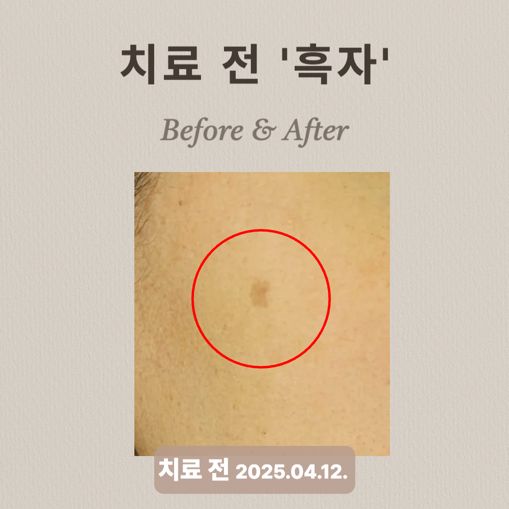 흑자