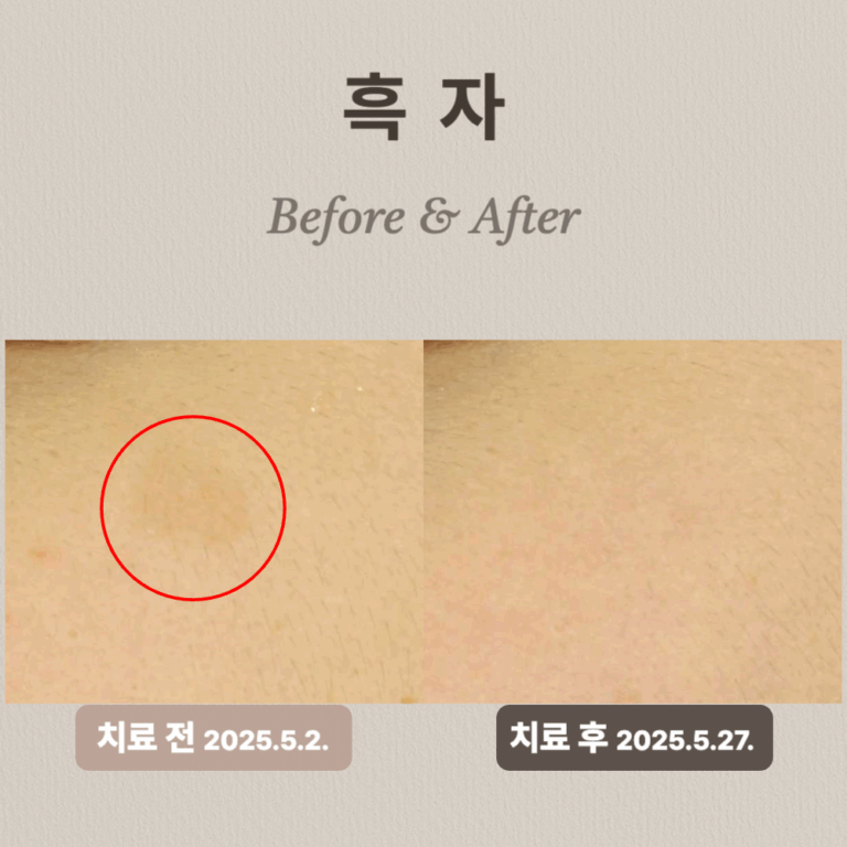 20대 여성 흑자 제거 후기