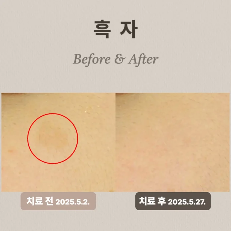 20대 여성 흑자 제거 후기