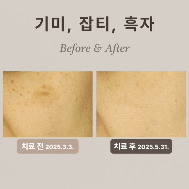 40대 여성 흑자 제거 후기 #기미, #잡티
