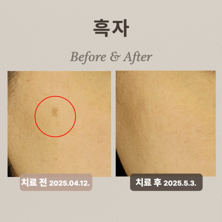 40대 여성 흑자 치료 후기