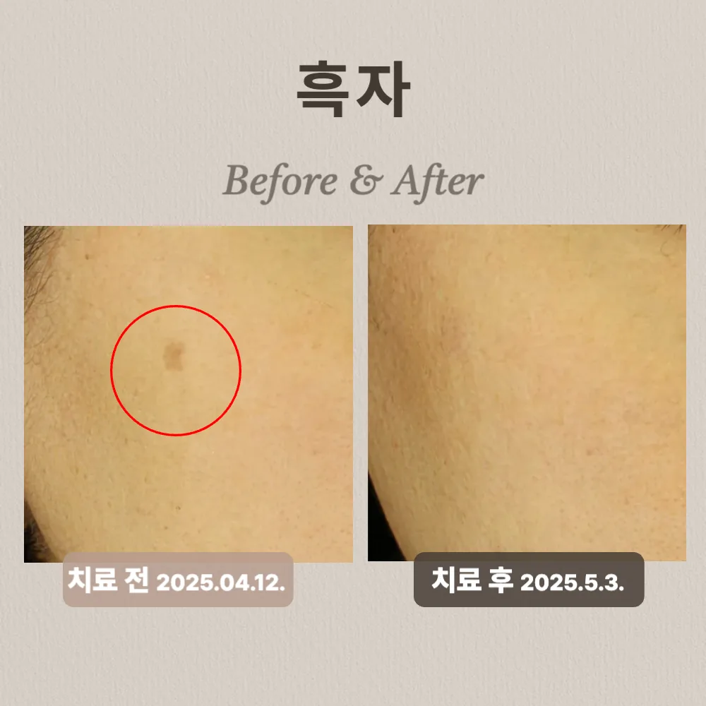 40대 여성 흑자 치료 후기