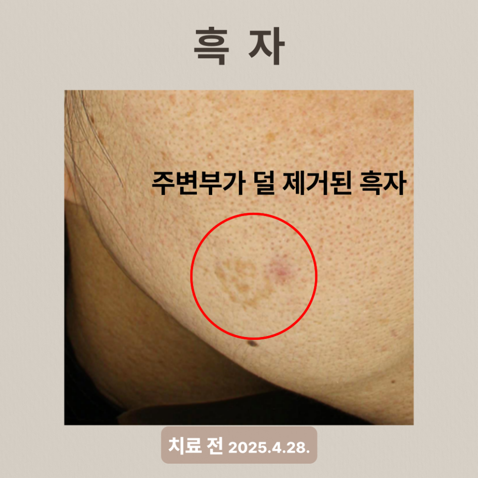 흑자