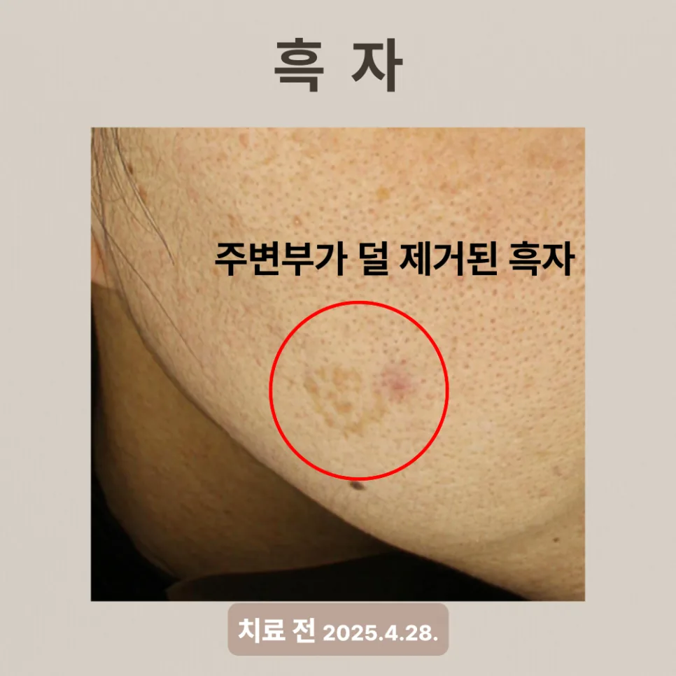 흑자 제거 후 색소 잔재가 남아 재치료하기 전