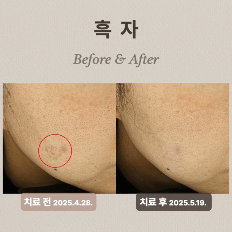 흑자 제거 부작용 치료 사례: 리팟레이저 치료 후기