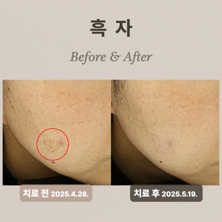 흑자 제거 부작용 치료 사례: 리팟레이저 치료 후기