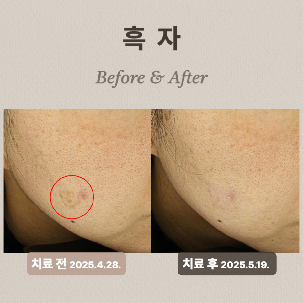 흑자