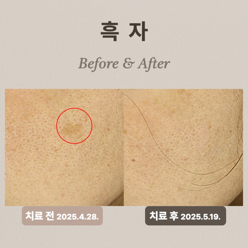 남은 흑자를 리팟레이저로 재치료한 뒤