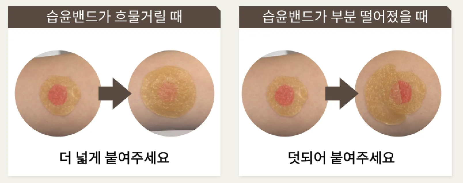 리팟(REEPOT) 시술 후 습윤밴드 조치 안내