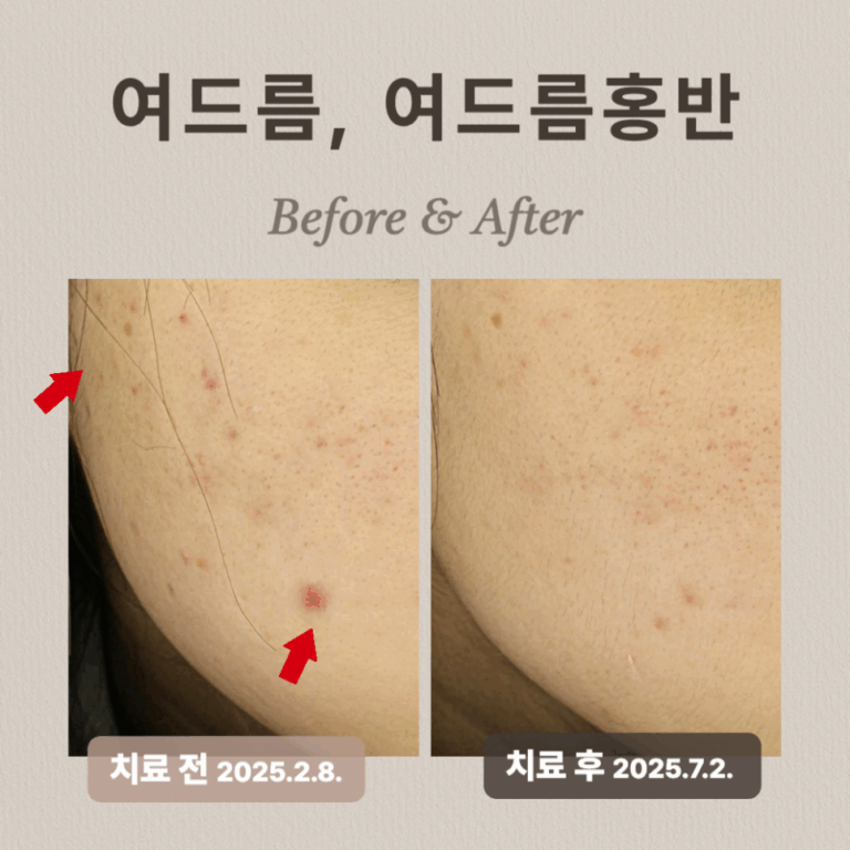 20대 여드름 붉은 자국, 브이빔 치료 후기와 효과는?