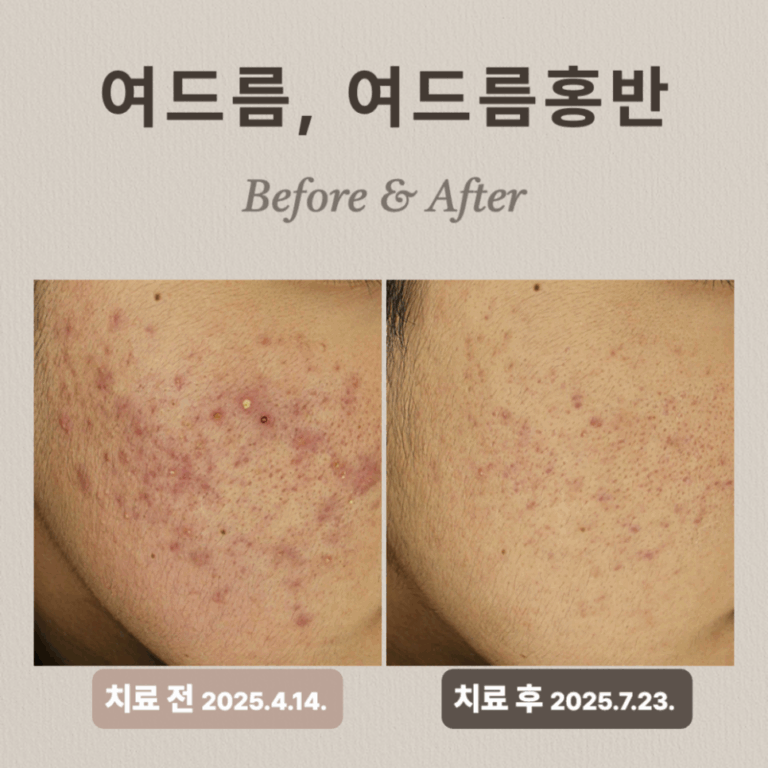 20대의 홍반 잡는 브이빔 시술 후기: 여드름 압출까지 완벽!