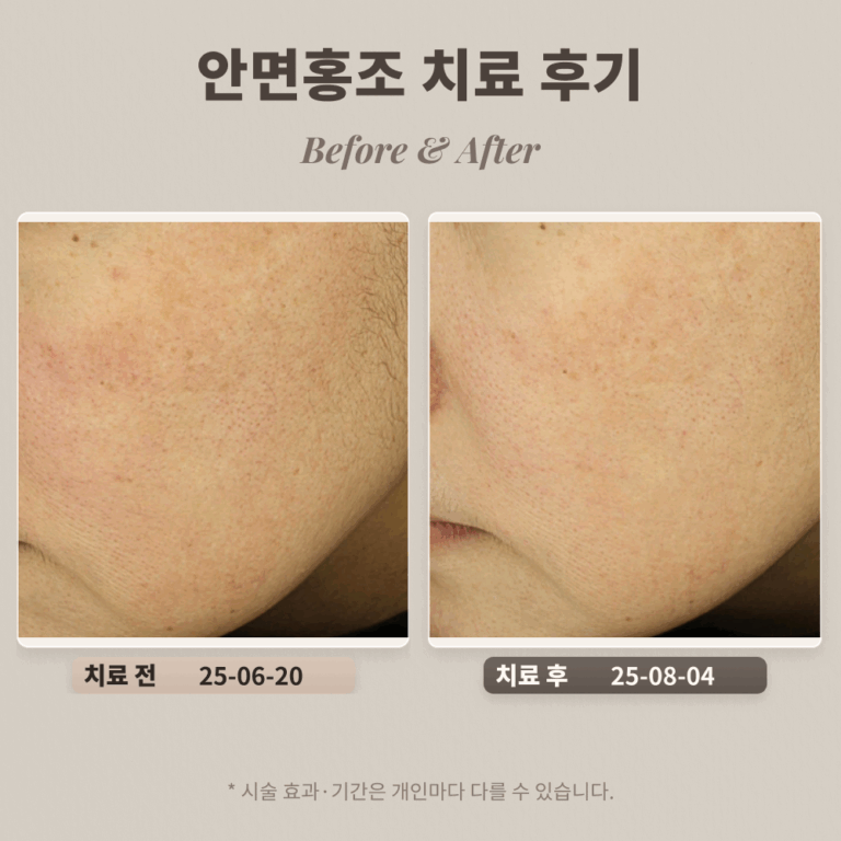 40대 여성 안면홍조, 붉은자국 치료 후기_대치동피부과전문의