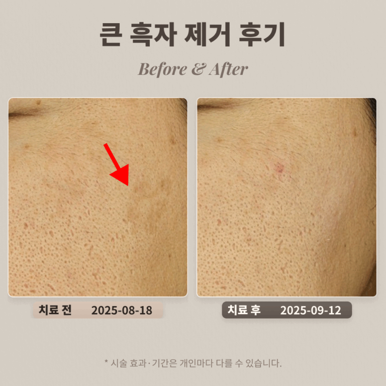 40대 남성 큰 흑자 제거 후기