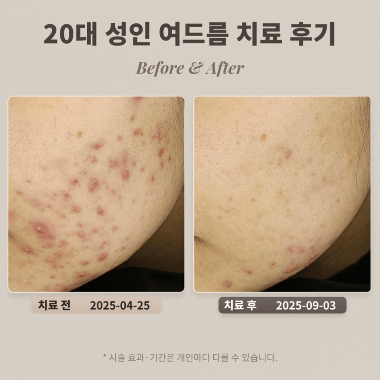 20대 여성 턱과 볼에 난 성인 여드름 치료 후기_대치동피부과