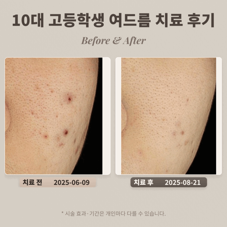 10대 고등학생 여드름 치료 후기_대치동 피부과