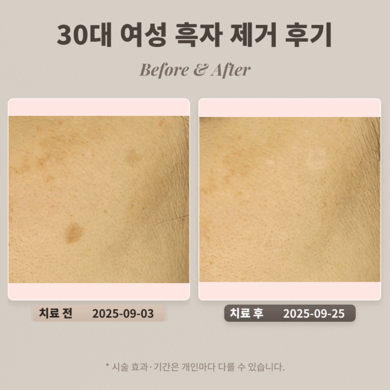 30대 여성 흑자 제거 후기 #얼굴에 난 갈색 반점