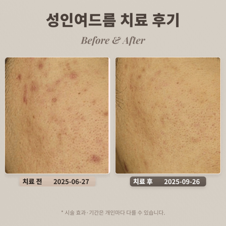 20대 성인여드름 치료 후기 #한티역피부과전문의