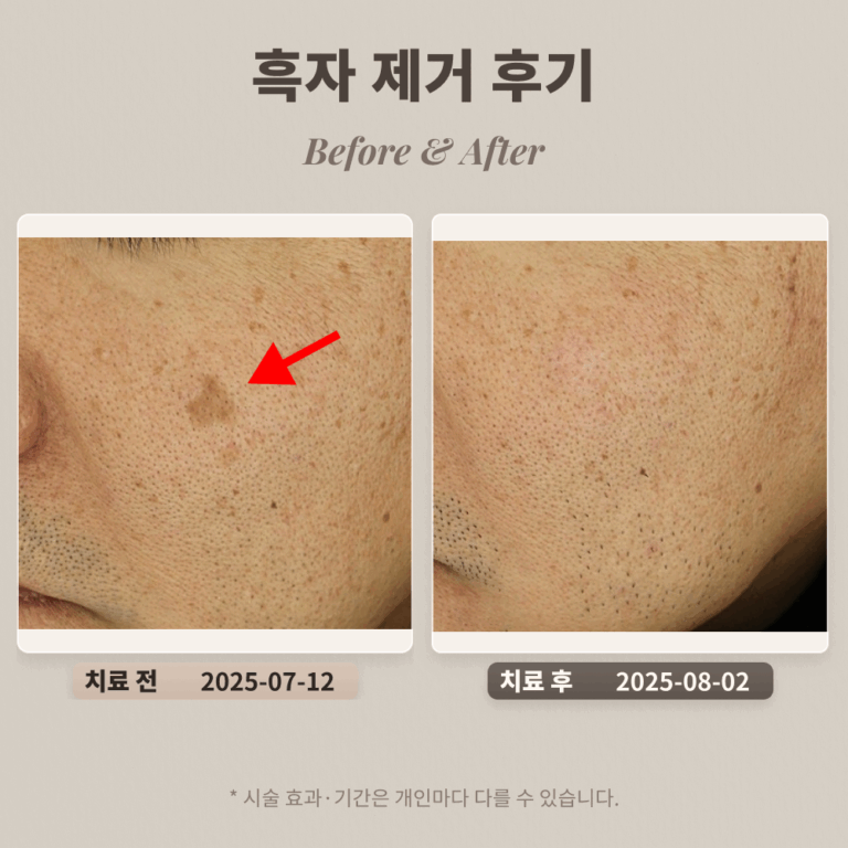 40대 남성 흑자 제거 후기