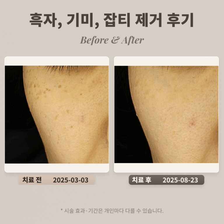 40대 여성 흑자, 기미, 잡티 제거 후기_한티역피부과 후기