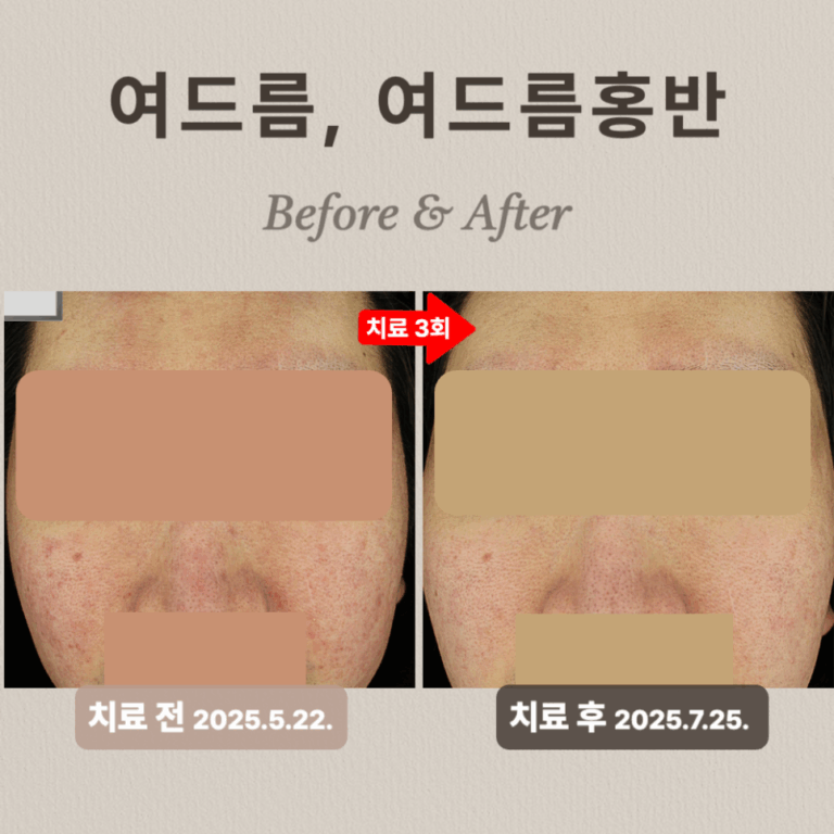20대 여드름 압출과 브이빔 치료 후기, 횟수별 효과는?