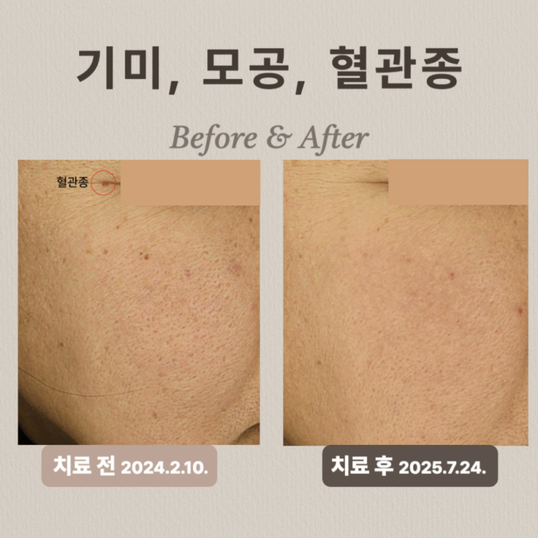40대 도자기 프로그램 후기: 기미·모공 개선 비법!