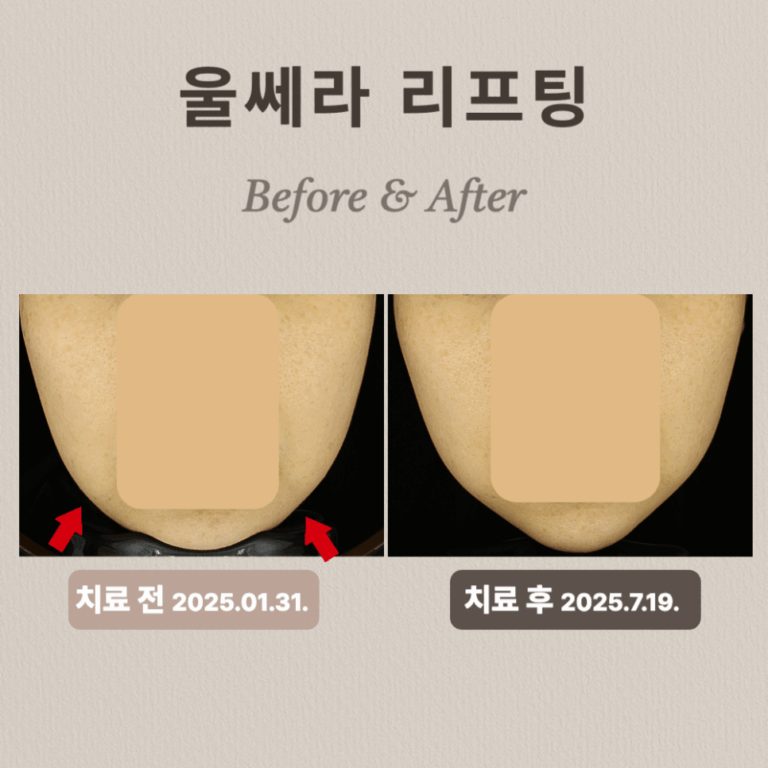 30대 광대 흑자 울쎄라·리팟레이저 시술 후기