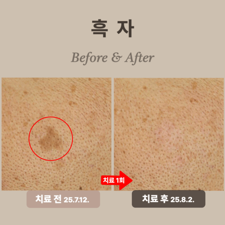50대 리팟레이저 시술 후기: 경계 뚜렷한 흑자 제거 성공!