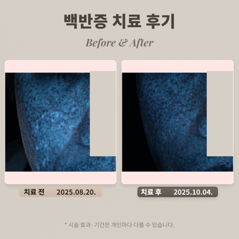 40대 백반증 남성 치료 후기 #백반증 치료기간 길까?