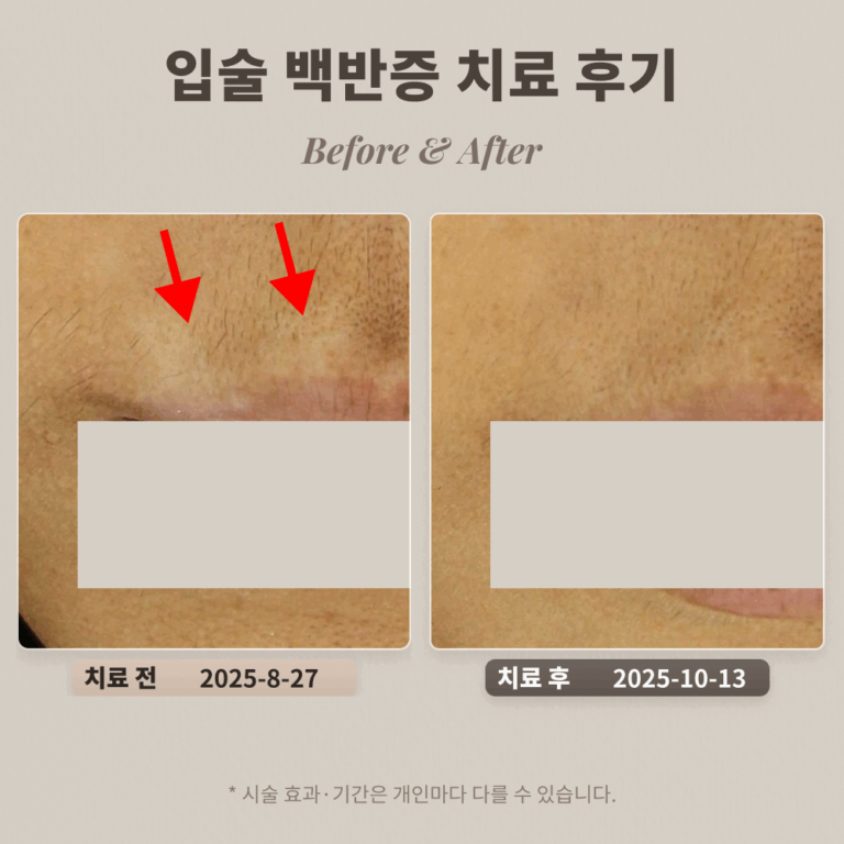 30대 입술 백반증 치료 후기 #백반증 조기 치료 방법