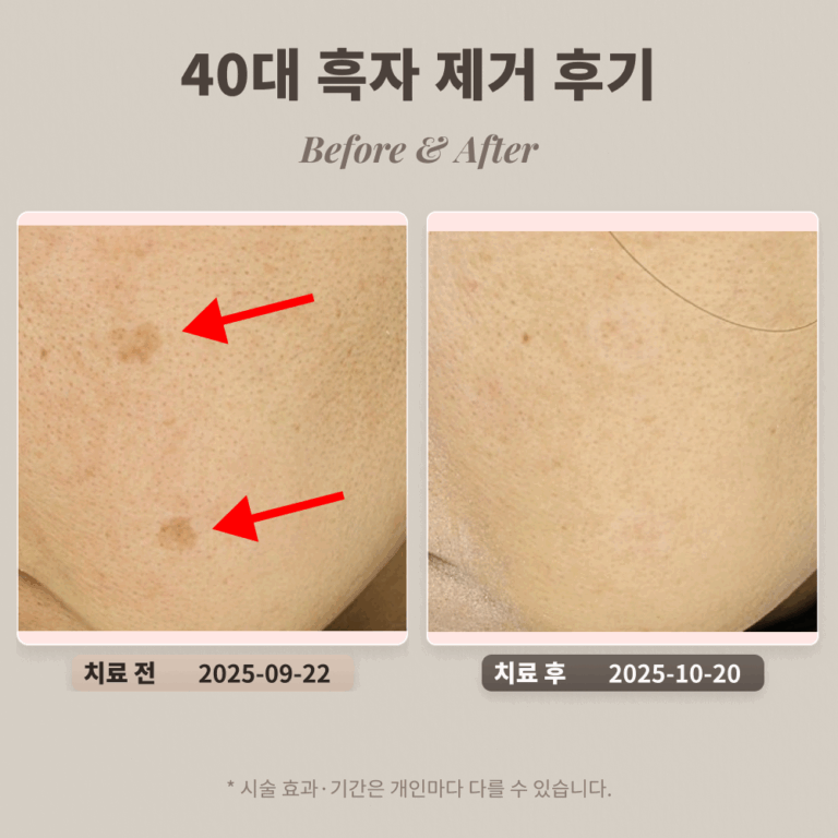40대 일광 흑자 제거 후기 #강남피부과전문의