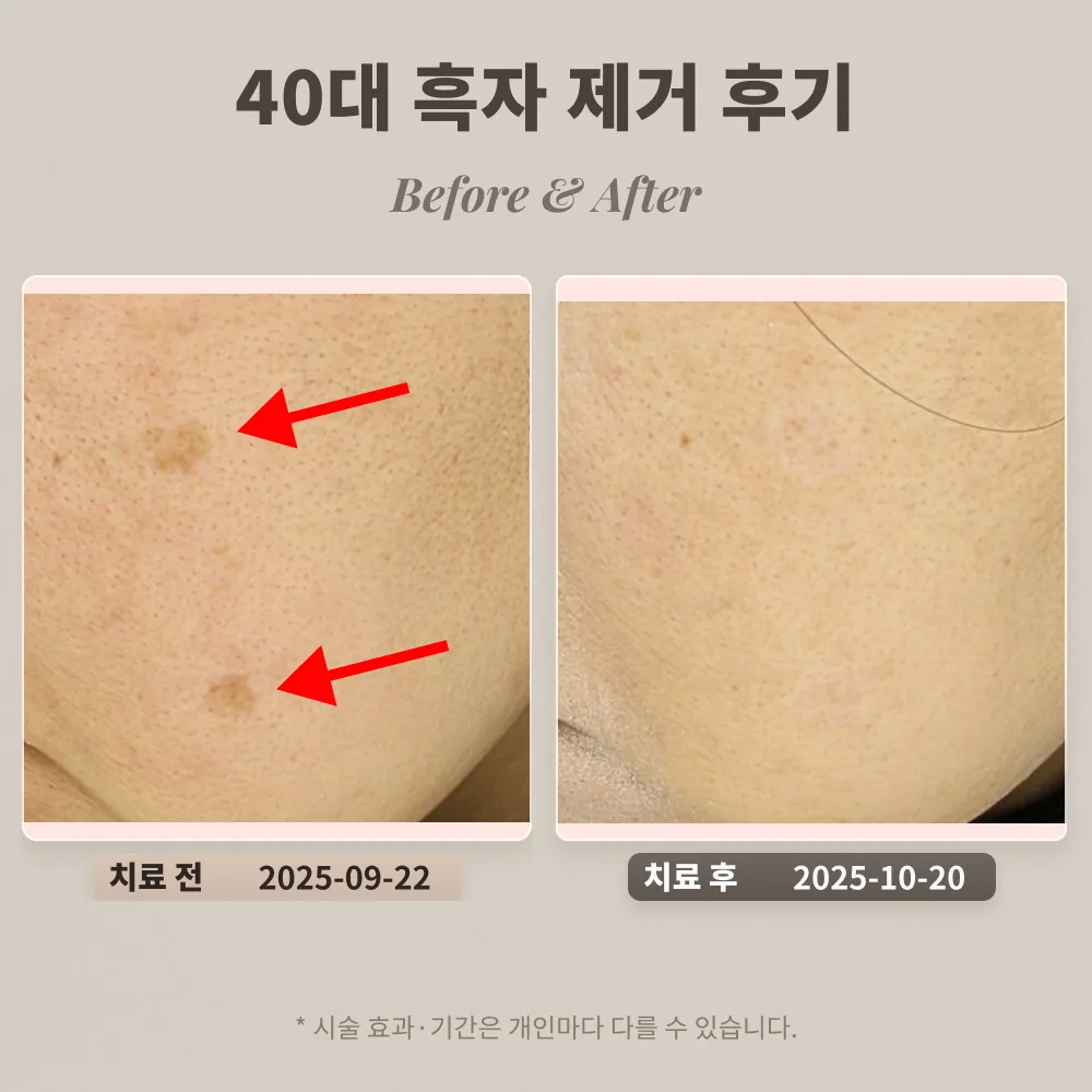 40대 일광 흑자 제거 후기 #강남피부과전문의