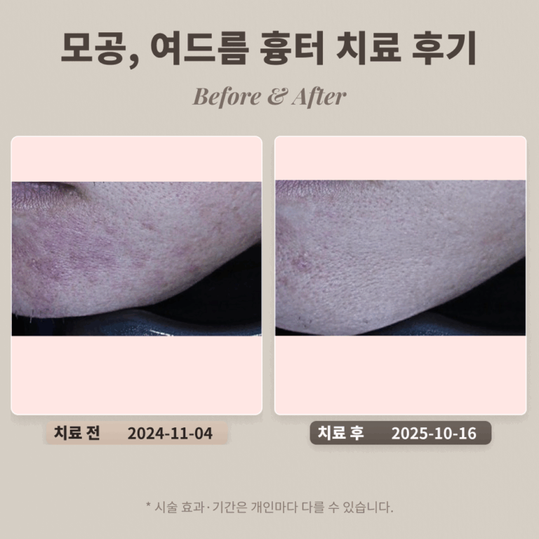 모공, 여드름 흉터 치료 후기 #도자기 피부를 위한 치료과정