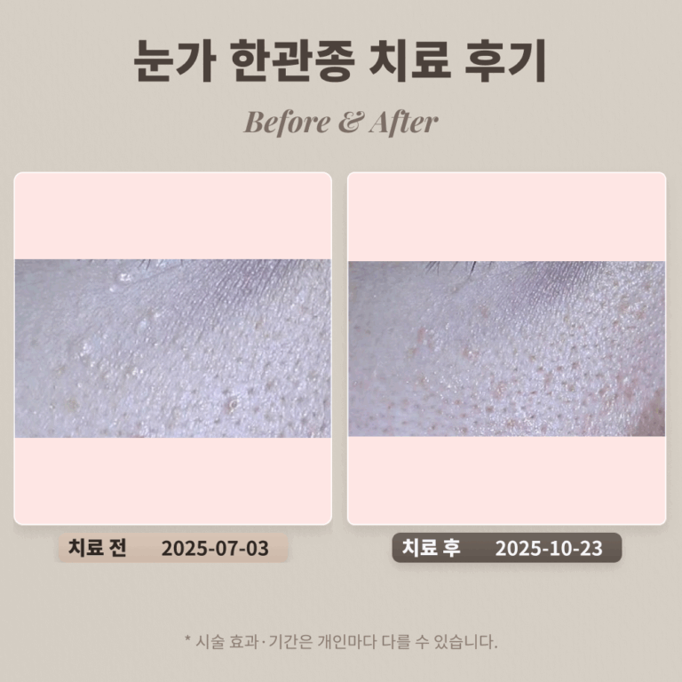 눈가 한관종 치료 후기 #비립종, 편평사마귀와 비교되는 한관종