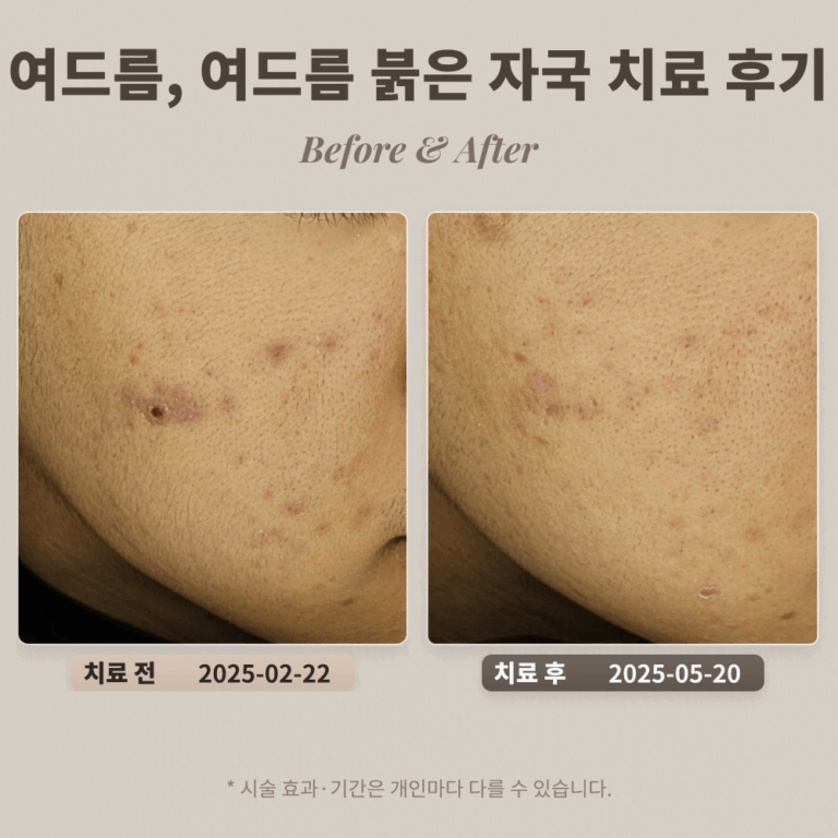 10대 여드름, 여드름 붉은 자국 치료 후기