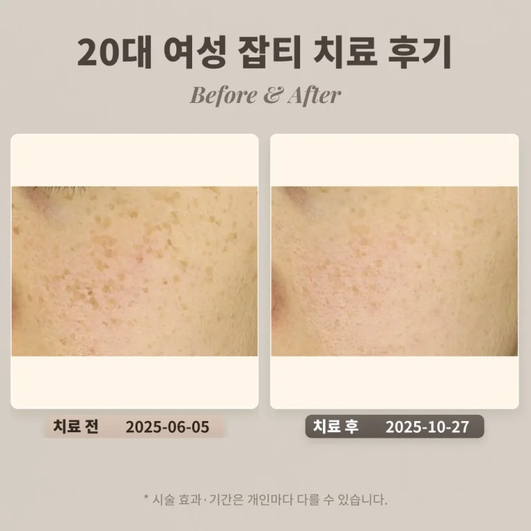 20대 여성 잡티 치료 후기