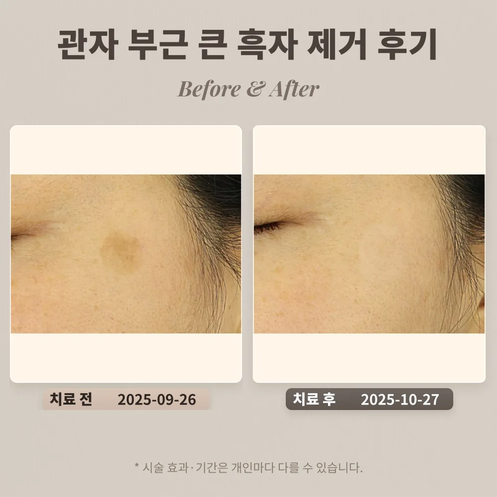 30대 여성 관자 부근 큰 흑자(갈색 반점) 제거 후기