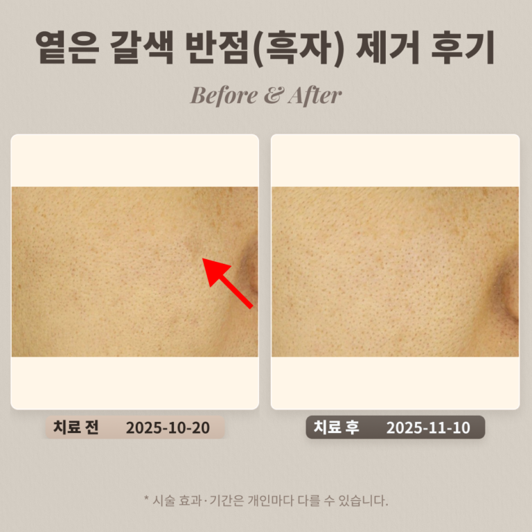 30대 옅은 갈색 반점(색소침착으로 오인) 제거 후기