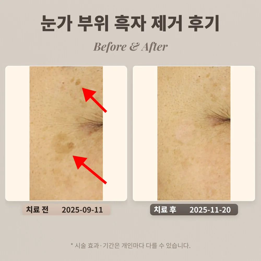 40대 여성 눈가 부위 흑자 제거 사례