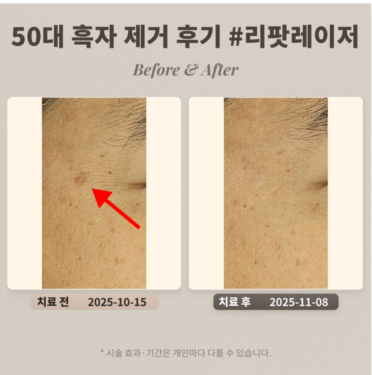 50대 흑자 제거 레이저 치료 후기 #리팟레이저