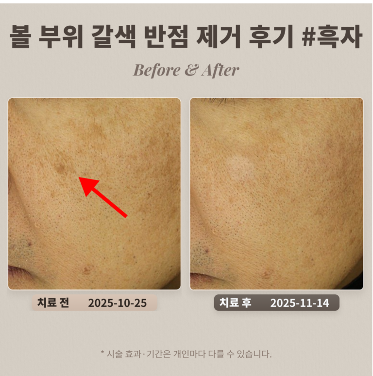 볼 부위 갈색 반점(흑자) 제거 후기 #흑자 제거 레이저 치료