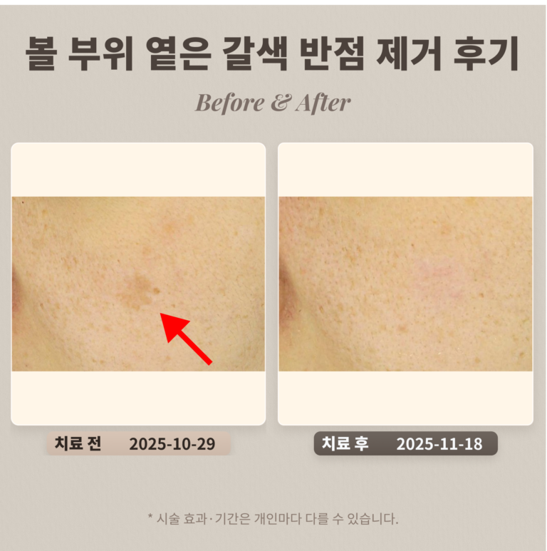30대 여성 볼 부위 큰 옅은 갈색 반점(흑자) 제거 후기