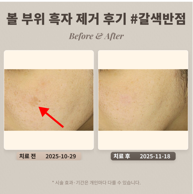 30대 볼 부위 흑자 리팟레이저로 제거 후기 #갈색반점