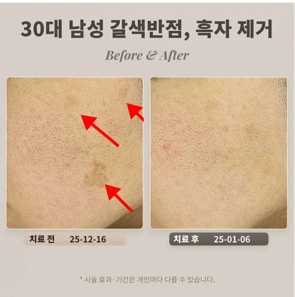 Removal of Brown Spots and Lentigines in a Man in His 30s_REEPOT Laser Review