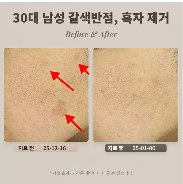 30대 흑자 제거 후기, 관자·볼 아래 큰 갈색반점 (남성)