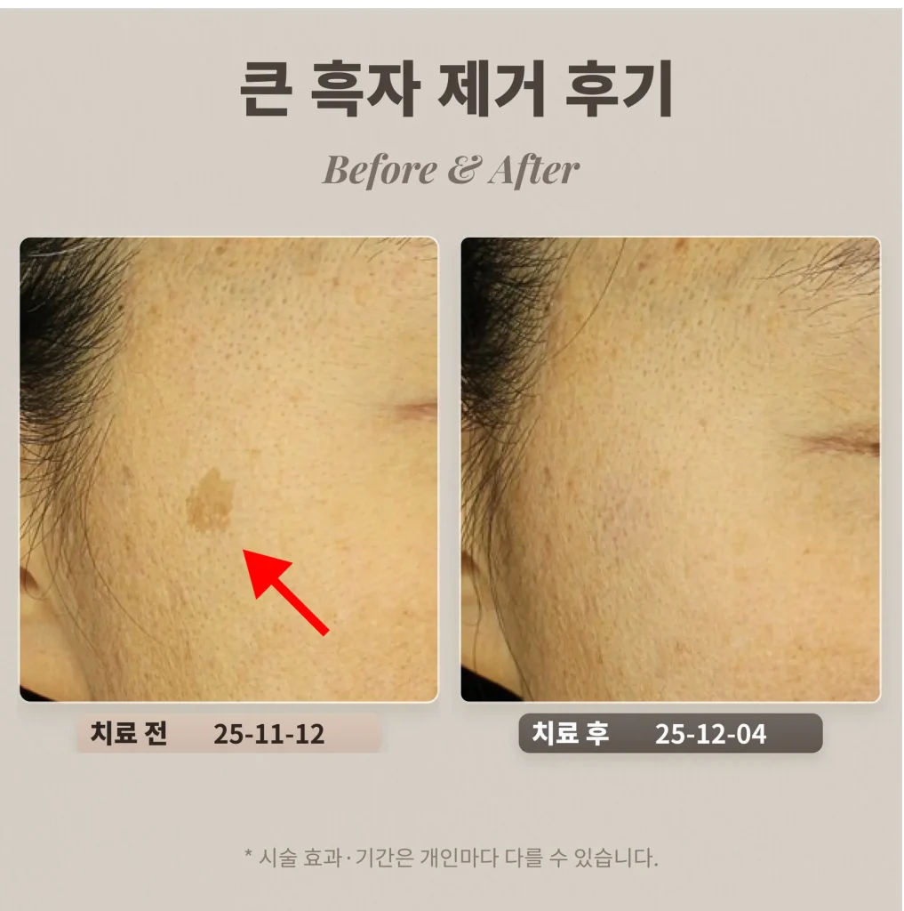 40대 눈가 큰 흑자 제거 후기_제거시 주의할 점