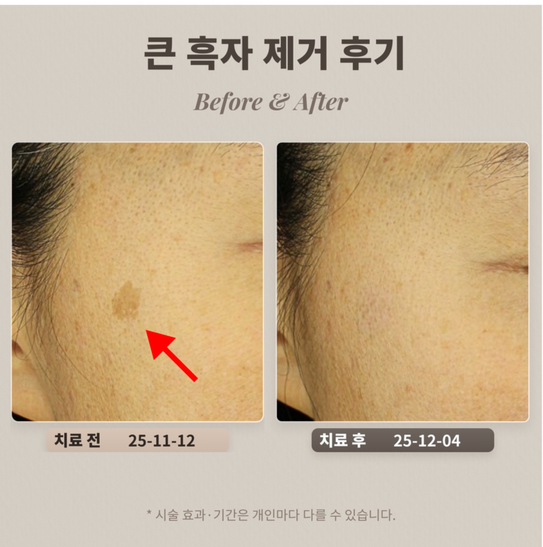 40대 눈가 큰 흑자 제거 후기_제거시 주의할 점